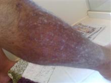 psoriasis leg before